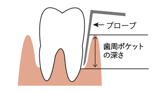 歯茎の検査